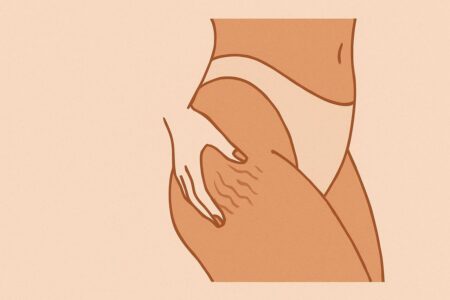 Minimalist illustration of a woman’s thigh showing cellulite texture.